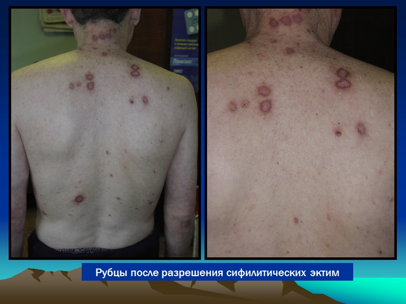 Рубцы после разрешения сифилитических эктим